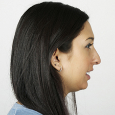 high-front-nonround profile